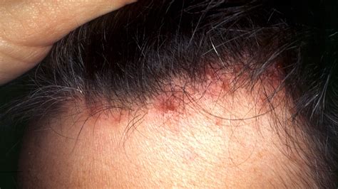 Red Itchy Bumps On Skin Causes Symptoms Pictures Trea - vrogue.co