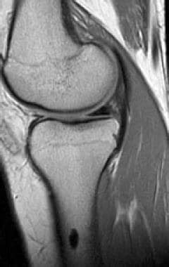 Bone Island Imaging: Practice Essentials, Radiography, Computed Tomography