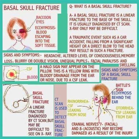 Basilar Skull Fracture | Nursing / Nursing School | Pinterest | Skulls