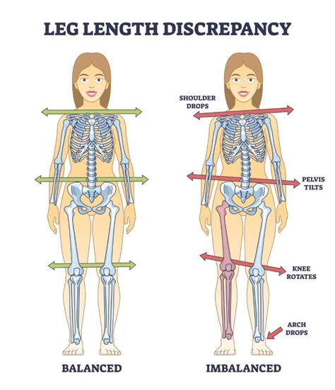 Leg Length Discrepancy: Ways You Can Correct It | CareXM