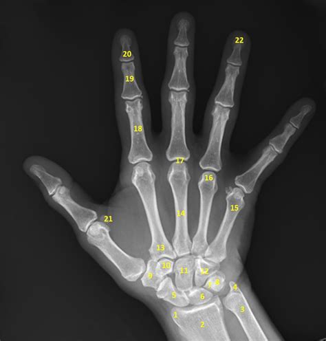 normal hand x-ray - Google Search | Anatomy bones, X ray, Radiology