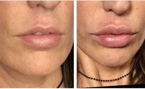 Pin by Adam Mauer MD on Lip injections | Lip injections, Injectables ...