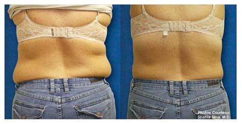 non-surgical body shaping | Allentown PA