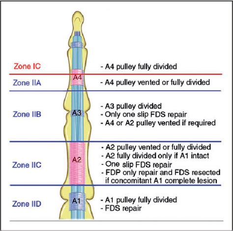 Fdp Tendon Repair Protocol : Jc flexor tendon injury, repair & rehabilitaion - Surgeon if the ...