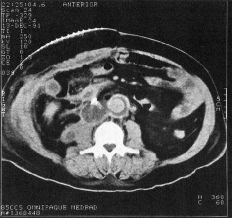 Clostridium septicum bacteremia associated with aortic graft infection - Journal of Vascular Surgery