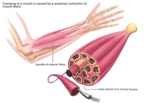 Muscle cramps? Role of Low Potassium & Magnesiums