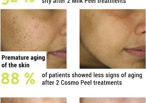 Chemical peeling – indications, types of peels, the course of the treatment – Healthy Food Near Me