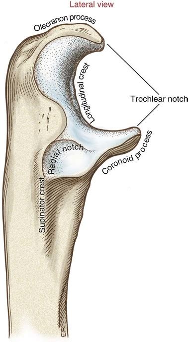 Radial Notch