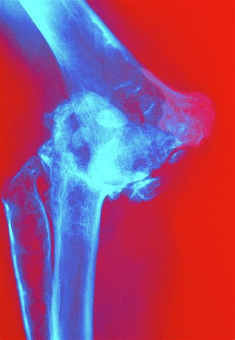 Col X-ray Of Rheumatoid Arthritis Of The Elbow Photograph by Medical Photo Nhs Lothian/science ...