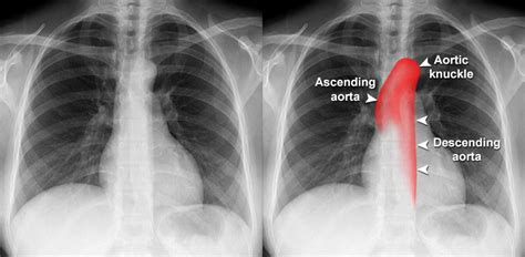 Chest X-ray - Quality - Normal chest X-ray - aortic unfolding