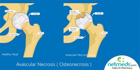 Long Covid Complications: What Is Avascular Necrosis Or Bone Death ...