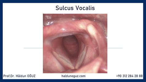 Sulkus Vokalis - Kulak Burun Boğaz Ses Hastalıkları