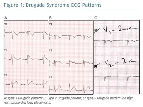 Brugada Syndrome ECG Patterns | Radcliffe Cardiology