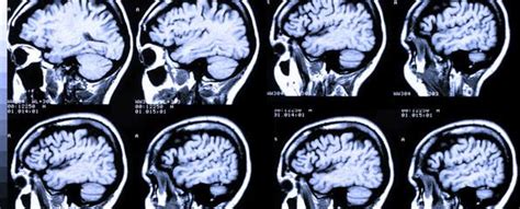 Brain imaging identifies bipolar risk | myVMC