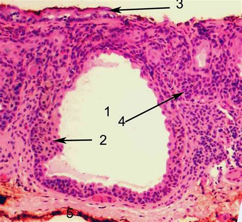 Ocular Pathology: Compound nevus- the answers