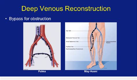 The Palma (femoro-femoral bypass) and May-Husni (saphenopopliteal... | Download Scientific Diagram