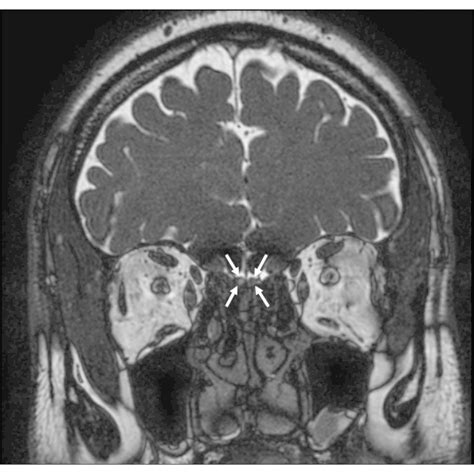 Olfactory Nerve Mri