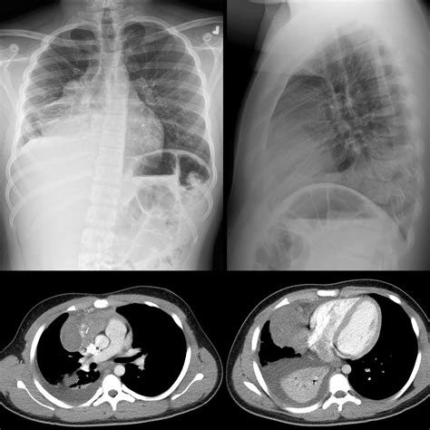 Pediatric Thymoma | Pediatric Radiology Reference Article | Pediatric Imaging | @pedsimaging