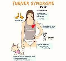 Turner Syndrome - Symptoms, Diagnosis, Treatment, Exercise