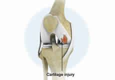 Knee Surgery Alexandria VA | Knee Specialist Arlington, Lorton VA