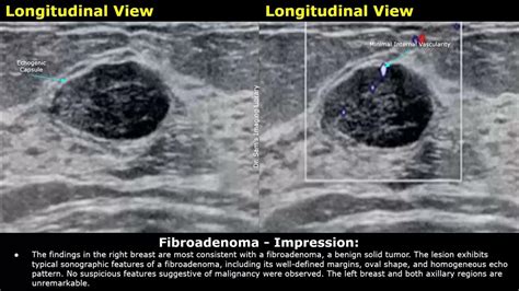 Fibroadenoma Breast Ultrasound Report Example | Benign Tumors USG Scan ...