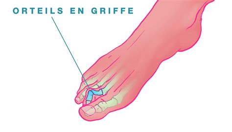 Orteils en griffe - Hallux Valgus Nice | Chirurgie pied Nice