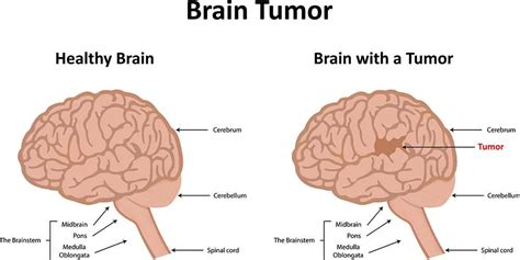 14 Brain Tumors Warning Signs; Symptoms of Brain Tumor - Left Side Pains