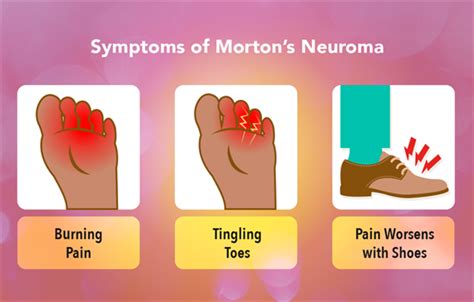 Morton’s Neuroma | My Doctor Online