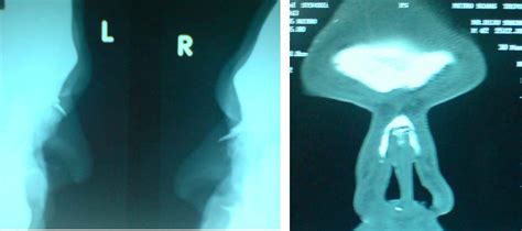 Nasal Bone Fracture-Treatment | Dr Paulose