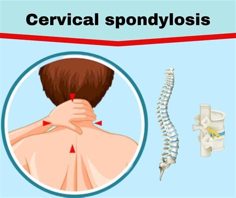 What is Cervical Spondylosis | The Prolotherapy Clinic