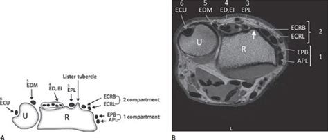 Wrist MRI | Radiology Key