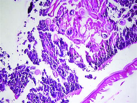 Intestinal lumen containing cellular debris, inflammatory cells and... | Download High-Quality ...