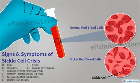 What is Sickle Cell Crisis and How is it Treated?