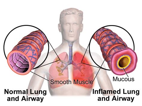 Management of Mild to Moderate Asthma Exacerbations - REBEL EM ...