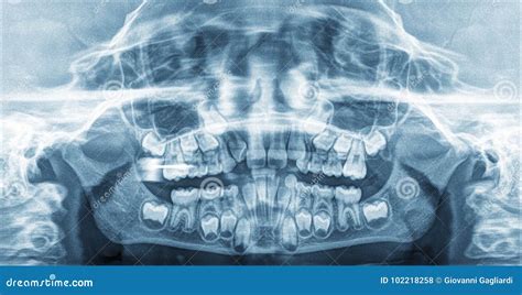 Panoramic X-Ray Teeth of a Child Stock Photo - Image of medicine ...