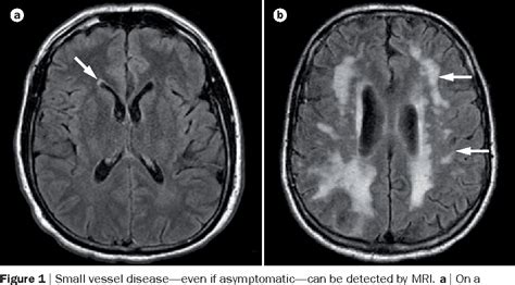 small vessel ischemic disease Cerebral csvd vascular svn bmj - Diseases ...