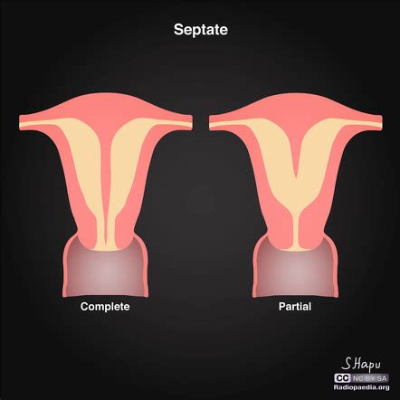 Septate uterus | Radiology Reference Article | Radiopaedia.org