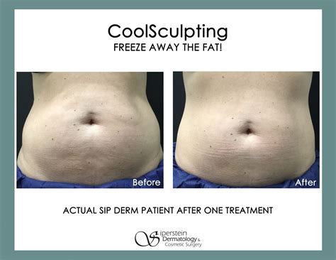 is it safe to do coolsculpting at home - Beautifully Web Log Picture Show