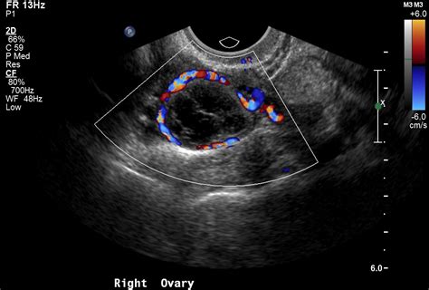 Ultrasound to Differentiate Benign From Malignant Ovarian Tumors—Are We There Yet? | The Scan