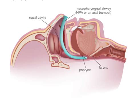 Nasopharyngeal Airway Anatomy