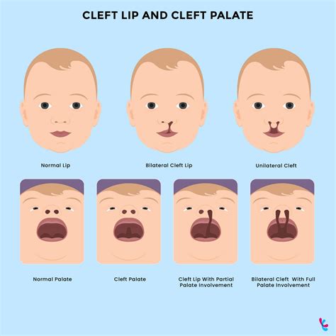 Is Cleft Lip Genetic? Facts about Cleft Lip and Palate