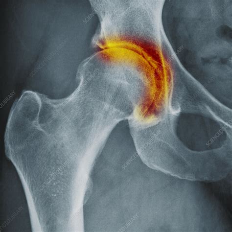 Hip arthritis, X-ray - Stock Image - C047/8903 - Science Photo Library