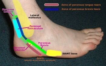 Peroneal Tendonitis & Injury - Dr. Jeremy M. Burnham, MD | Sports Medicine