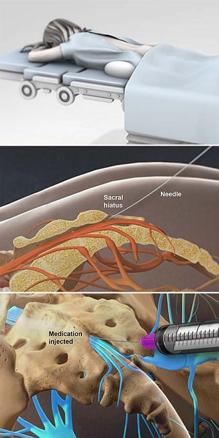 Caudal Anesthesia Technique