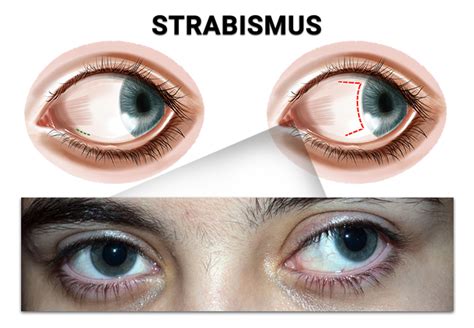 Strabismus (Crossed Eyes) NYC - Treatments For Ocular Misalignment