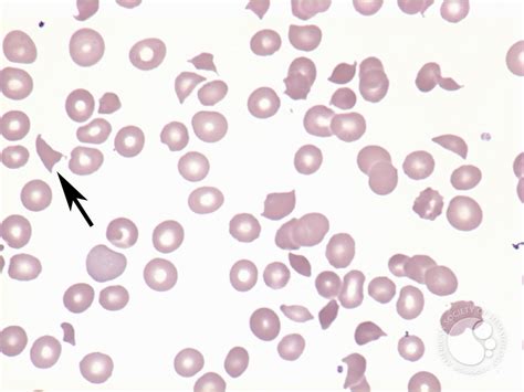 Microangiopathic hemolytic anemia - 1.