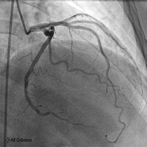 Left anterior descending artery - wikidoc