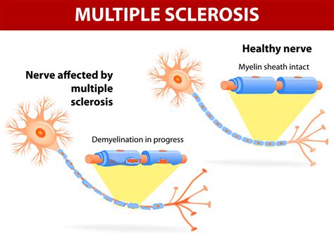 Your Child and Multiple Sclerosis in Renton WA