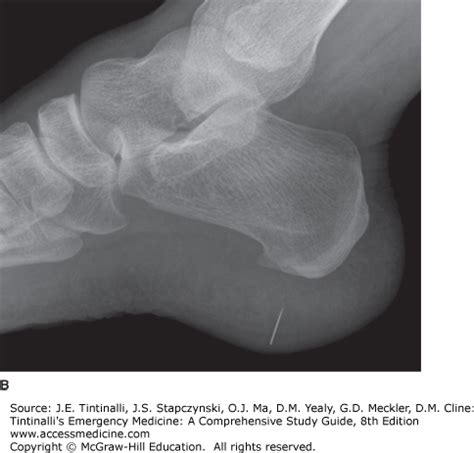 Nail Puncture In Foot Antibiotics - Nail Ftempo