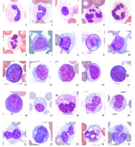 Reactive Lymphocytes Vs Monocytes